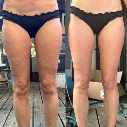 FlexSilk™ - Anti-Cellulite Massager